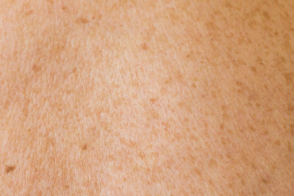Human skin texture with freckles
